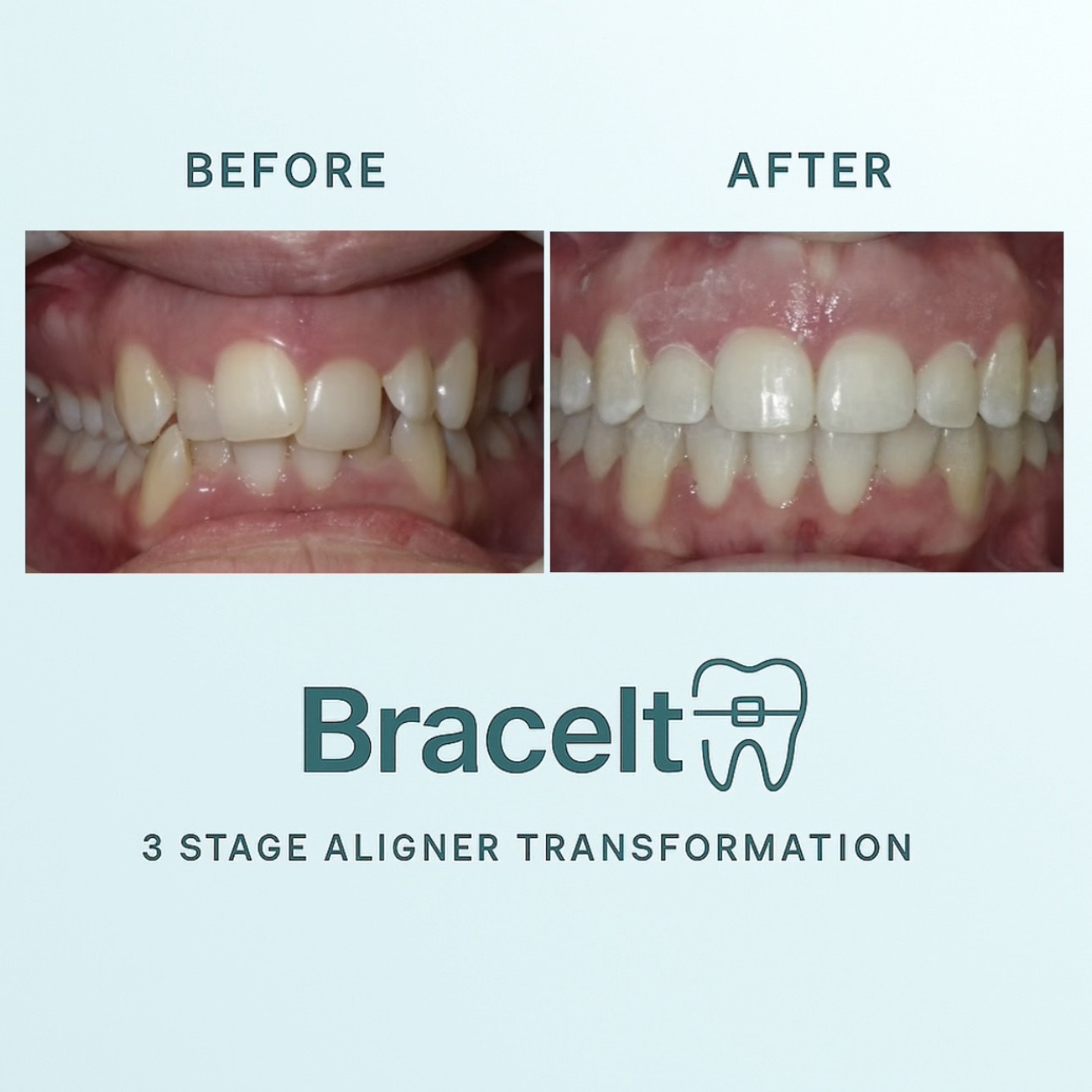 3 Stages Orthodontic Aligners