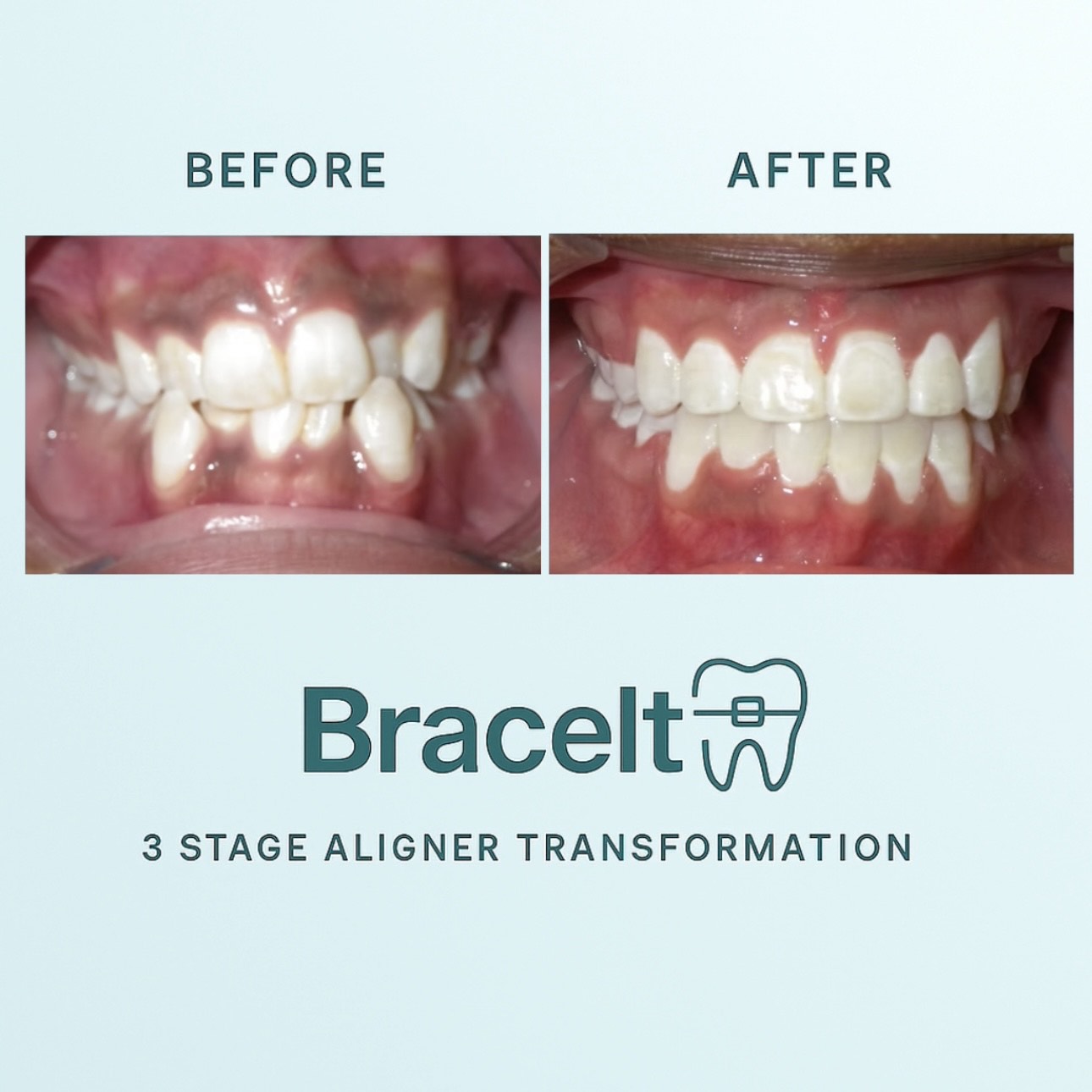 3 Stages Orthodontic Aligners