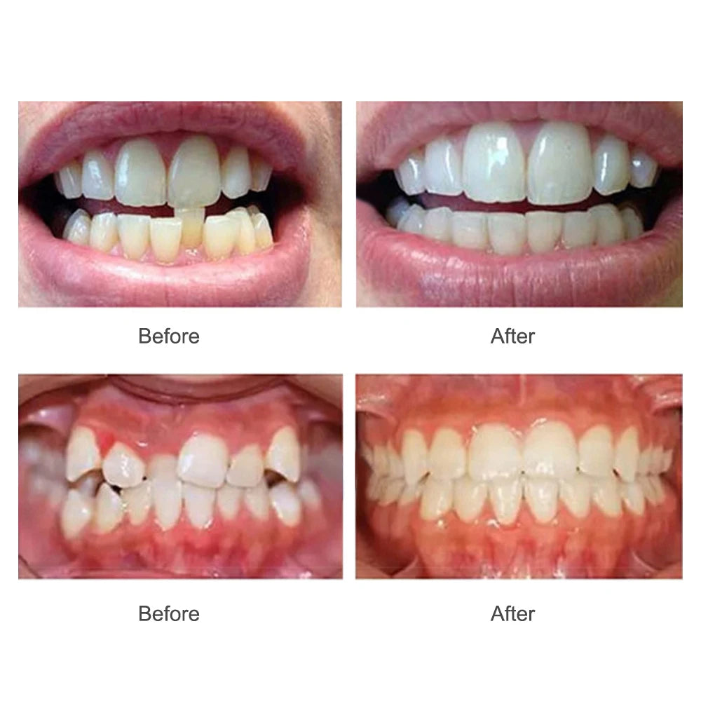 3 Stages Dental Braces