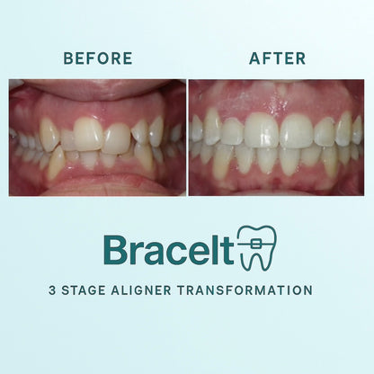 3 Stages Orthodontic Aligners